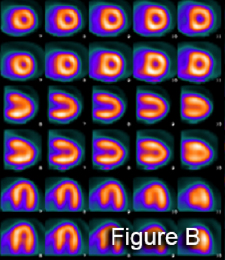 Cardiac PET Myocardial Perfusion Imaging